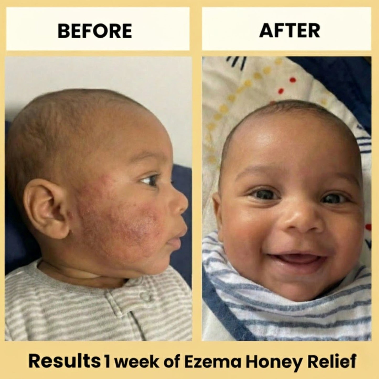 Eczema Honey Relief