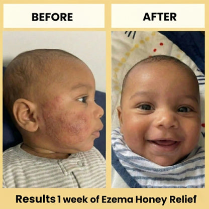 Eczema Honey Relief