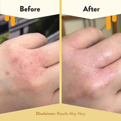 Eczema Honey Relief